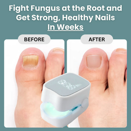Elite™ - Nail Fungus Laser Device