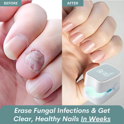 Elite™ - Nail Fungus Laser Device
