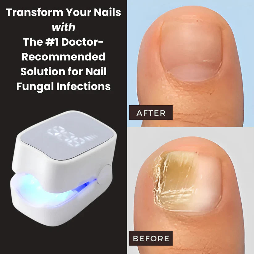 Elite™ - Nail Fungus Laser Device