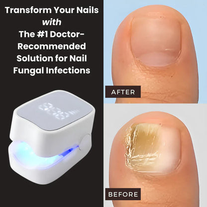Elite™ - Nail Fungus Laser Device